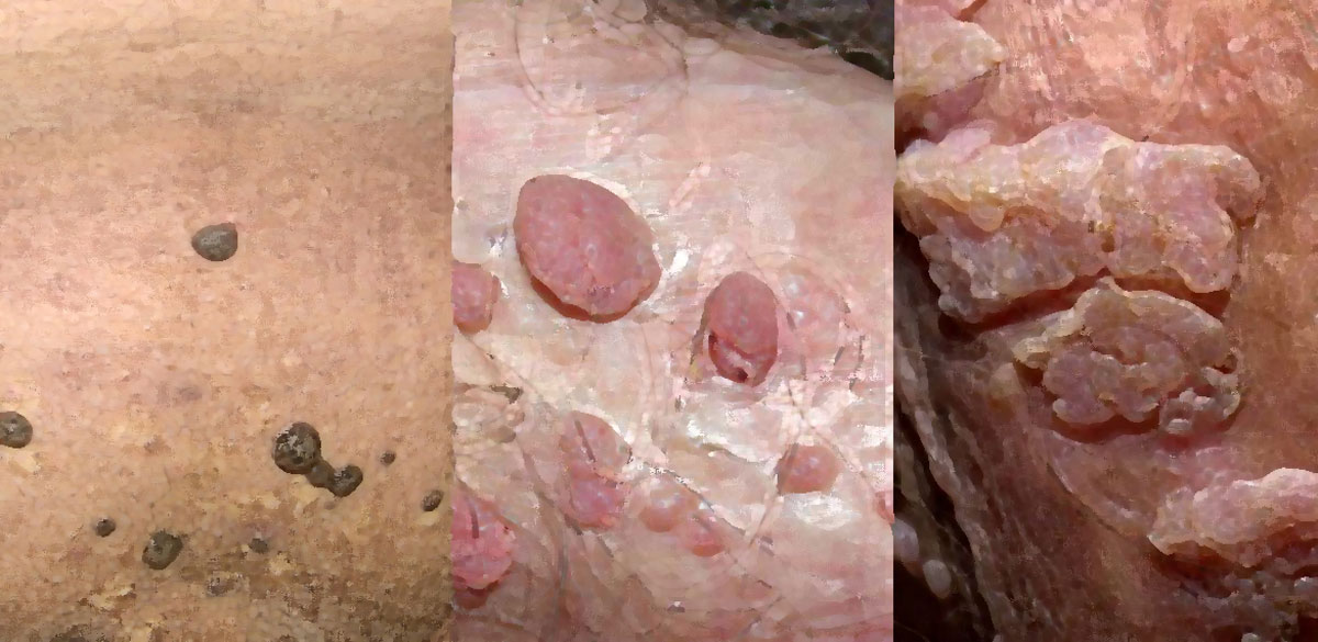 men-genital-warts-cover
